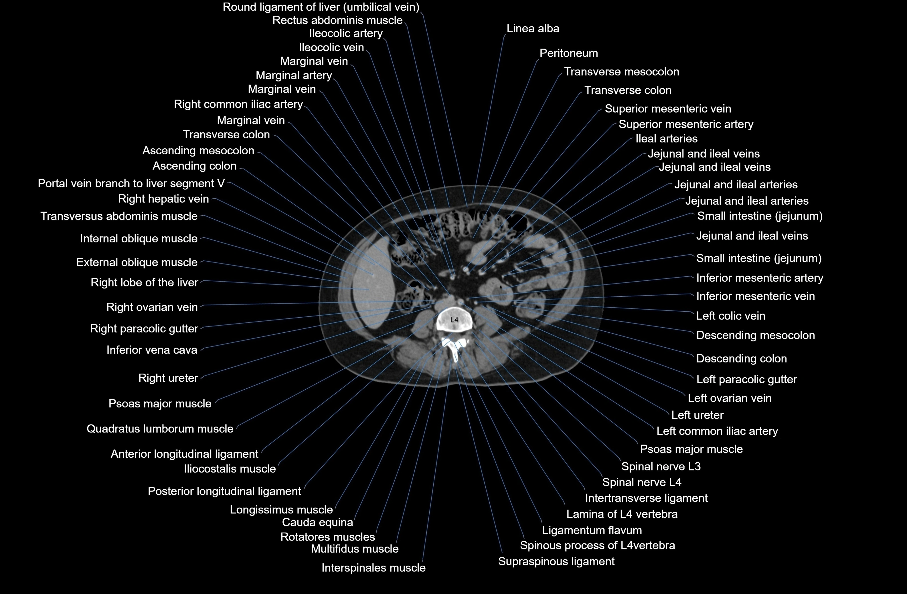 CT Abdomen axial cross sectional anatomy labelled radiology image-00052.webp